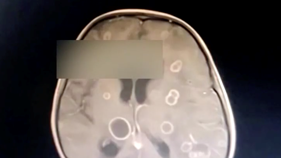 大扫除后女孩脑部感染 这些健康隐患要避开 大扫除后女孩脑部感染 这些健康隐患要避开