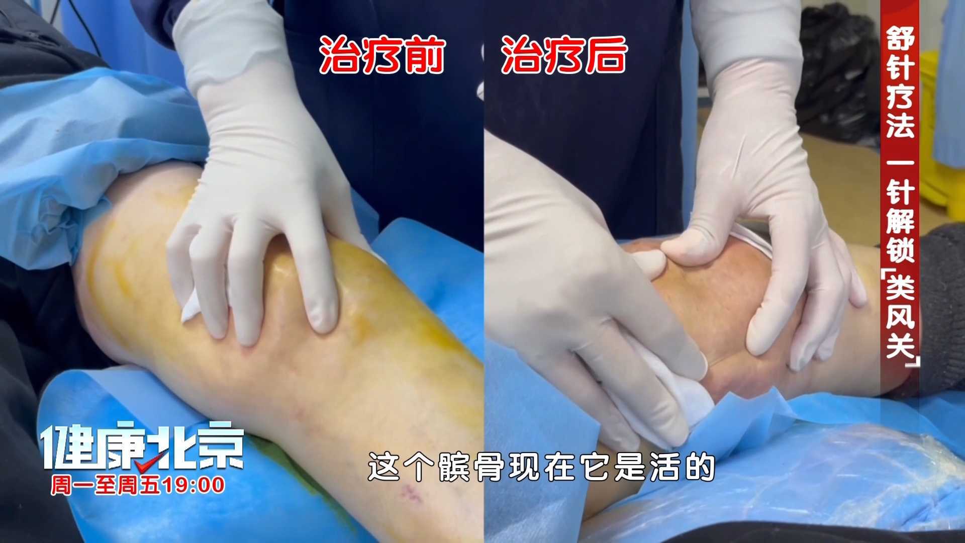 膝盖从畸形致残到功能恢复的舒针疗法! 膝盖从畸形致残到功能恢复的舒针疗法!