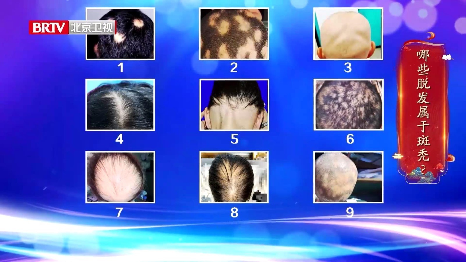 多种类型的脱发，哪一种属于斑秃？