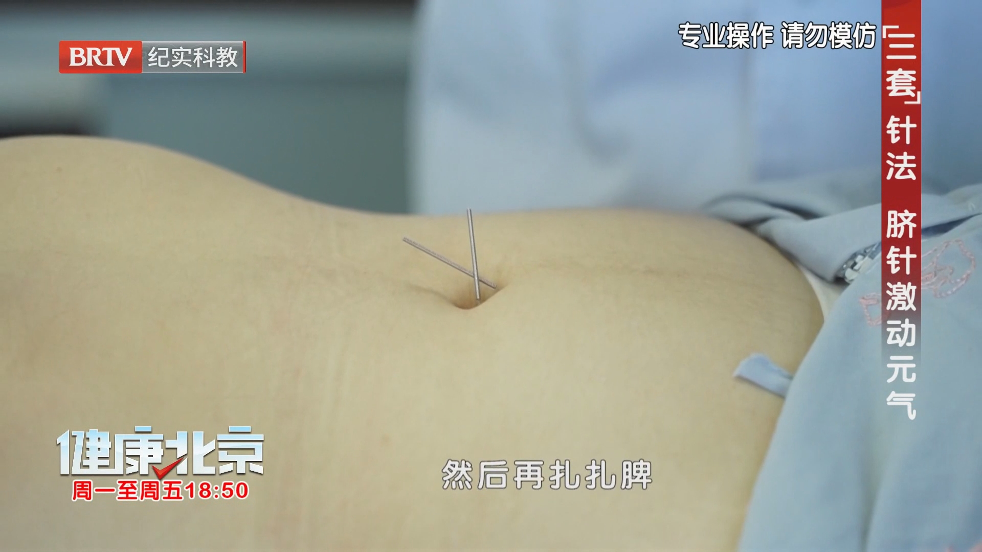 “三套”针法 脐针激动元气