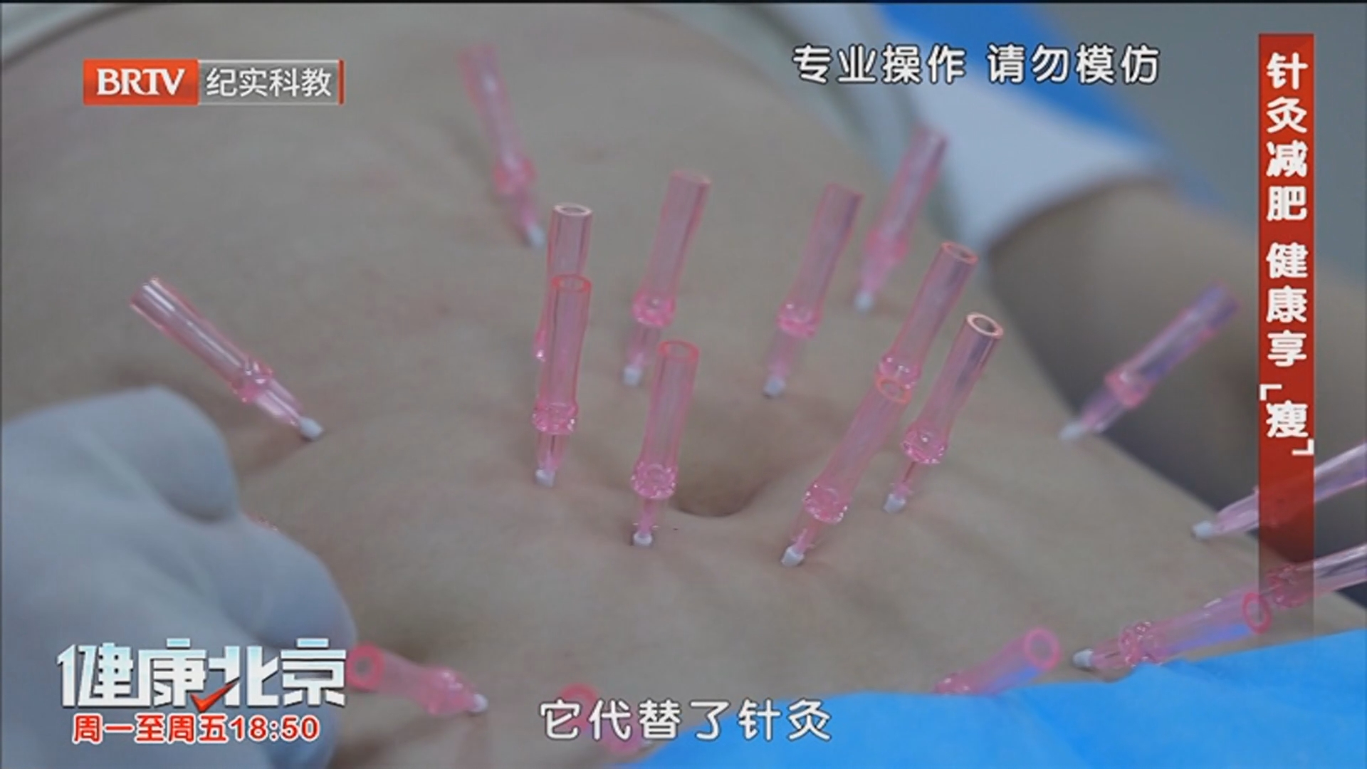 《健康北京》20260603针灸减肥 健康享“瘦”